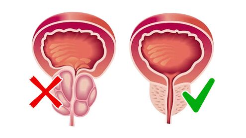 prostată înainte și după utilizarea Prostalinei